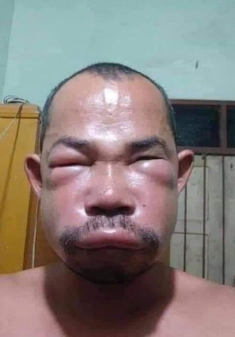 покусанный пчёлами