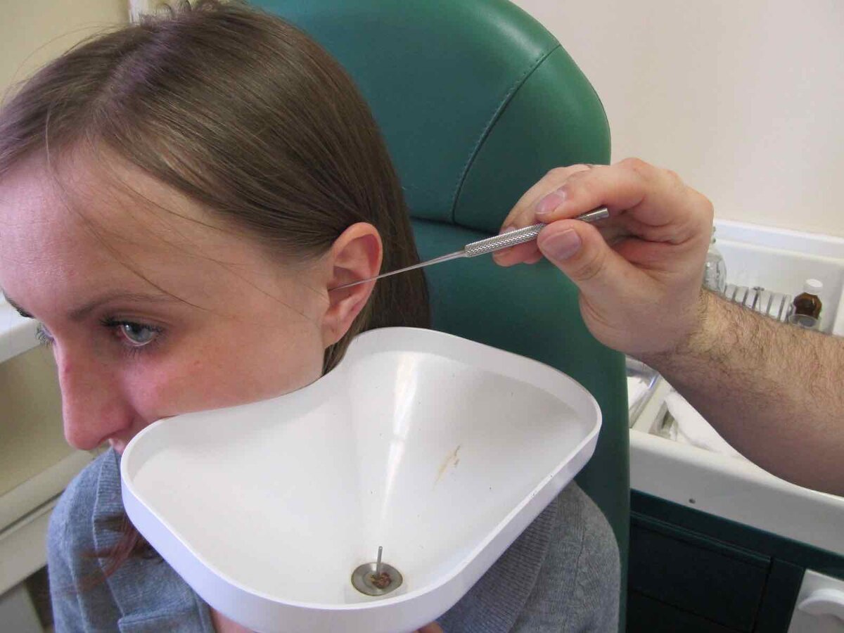 Удаление серной пробки