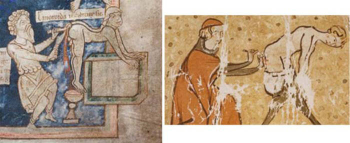 Лечение геморроя в средние века