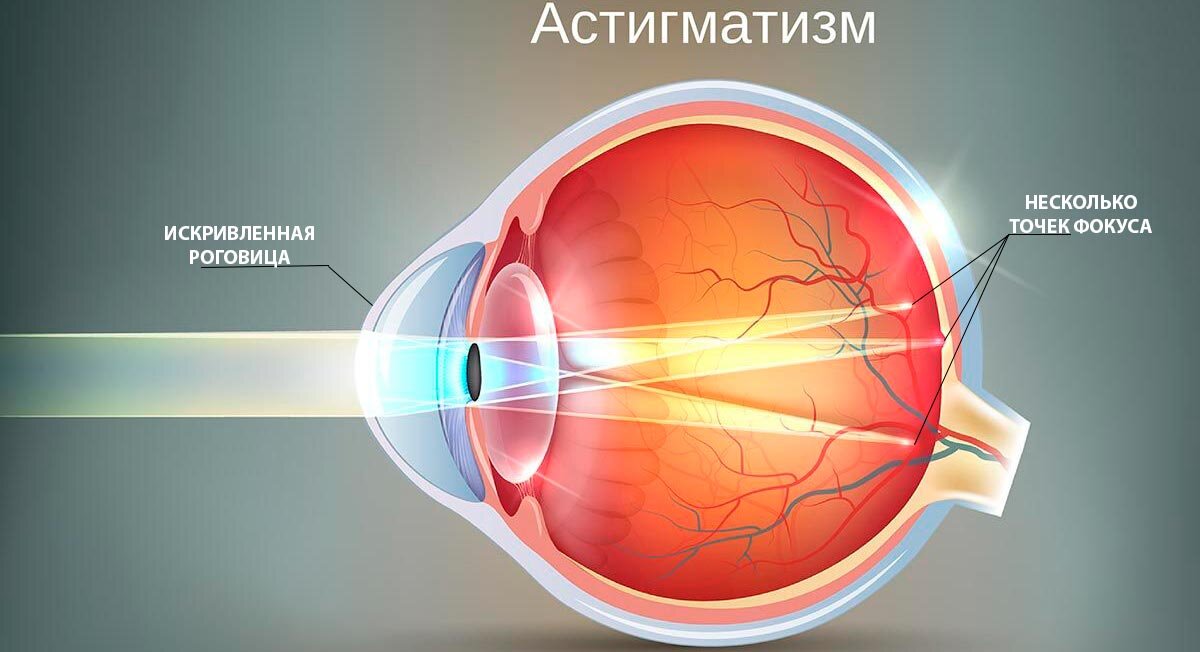 Что такое астигматизм