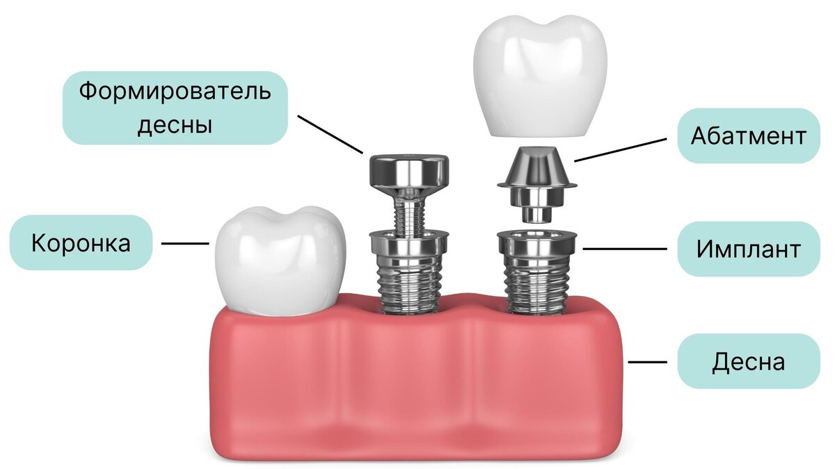Вид  дентального имплантата и его вспомогательные составляющие