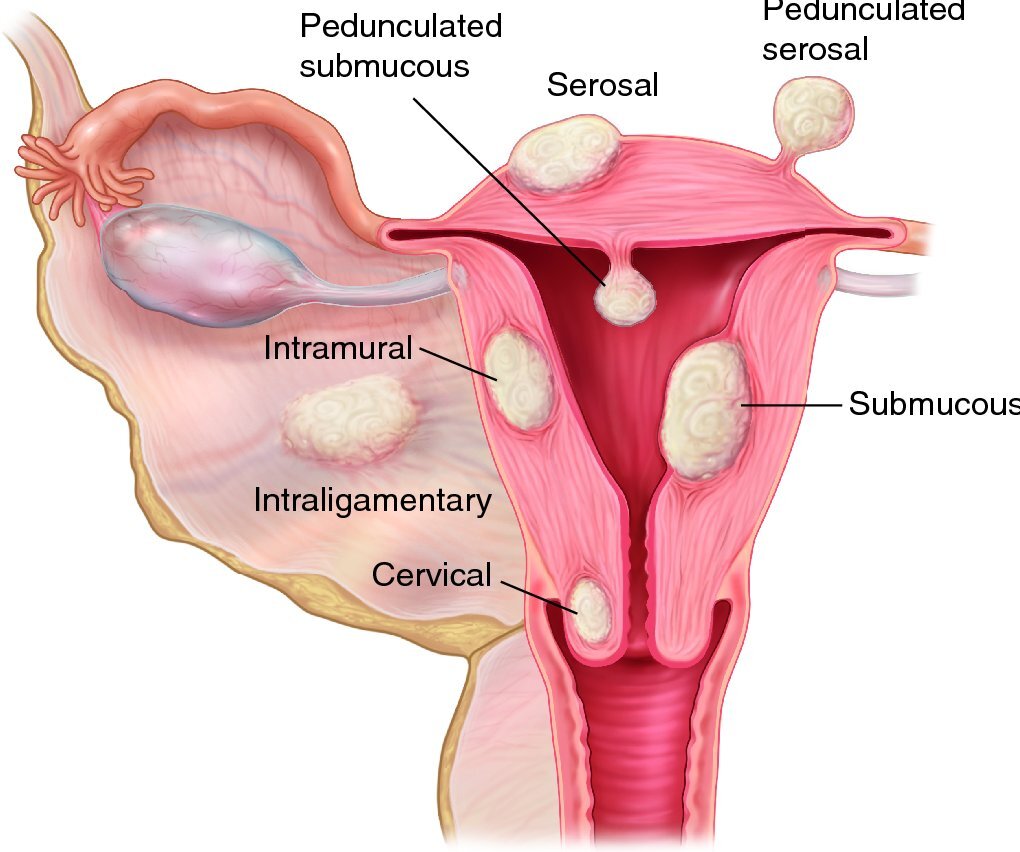Фиброма миома матки. Интралигаментарная миома.