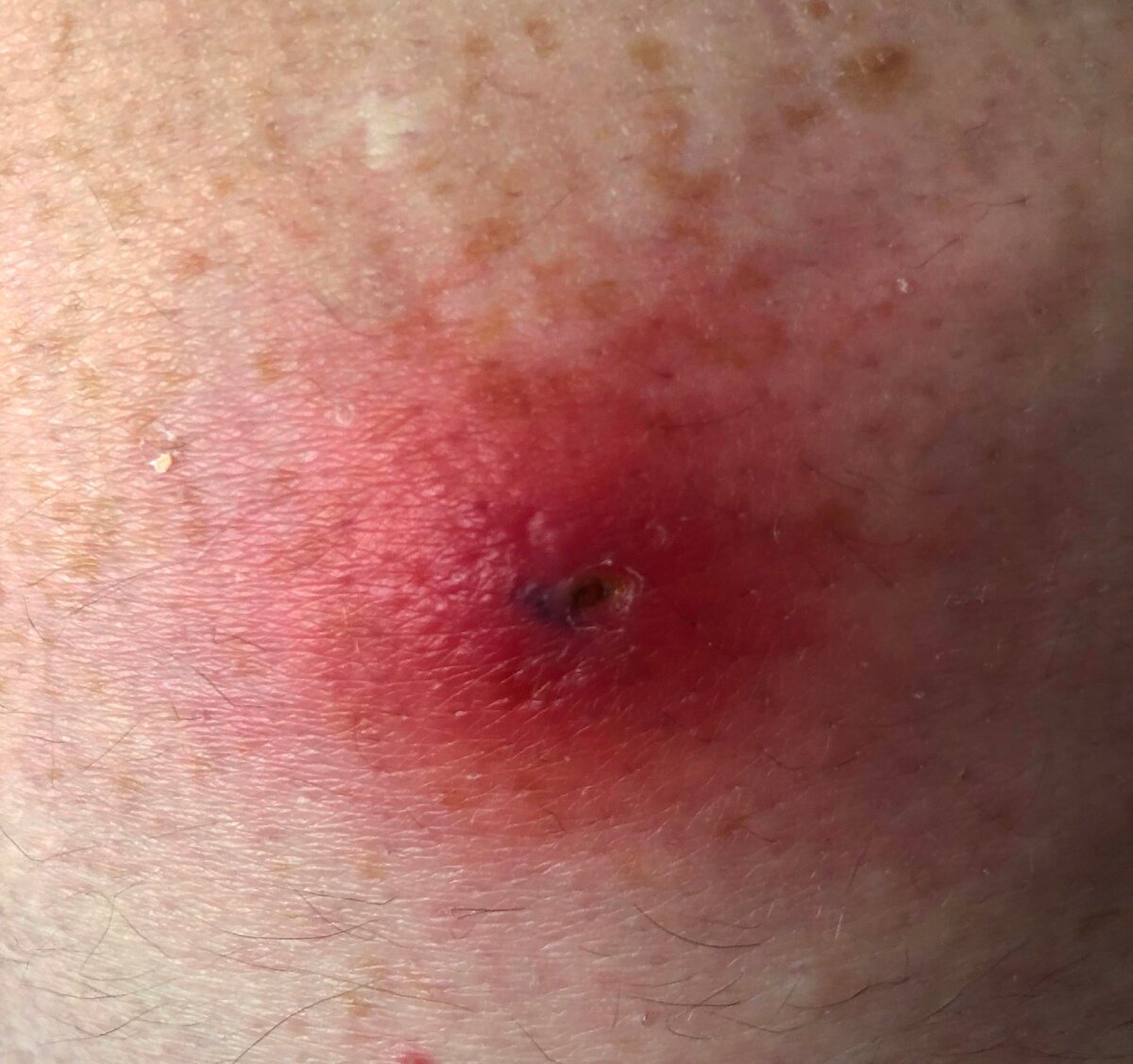 Лечение фурункулеза