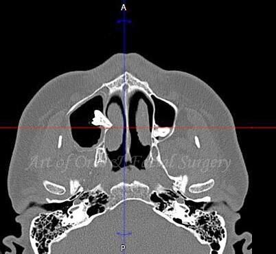 КЛКТ  - аксиальный реформат