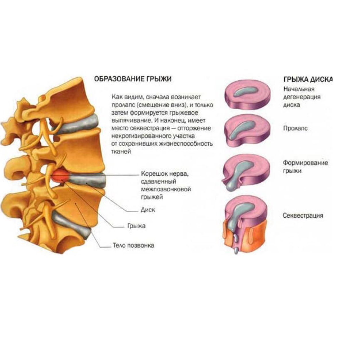 ПРИЧИНЫ МЕЖПОЗВОНОЧНЫХ ГРЫЖ. | Остеопат Легошин Дмитрий | Дзен