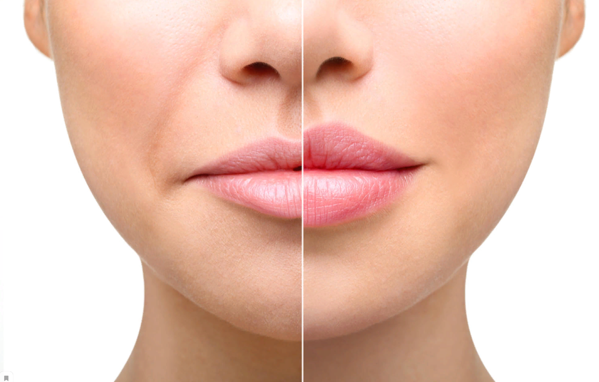 Контурная пластика позволяет за 1 сеанс устранить эстетические недочеты, придать губам манящий цвет и соблазнительный объем.