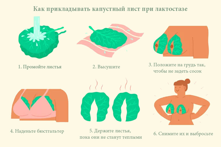 Помогает ли капустный лист при лактостазе?