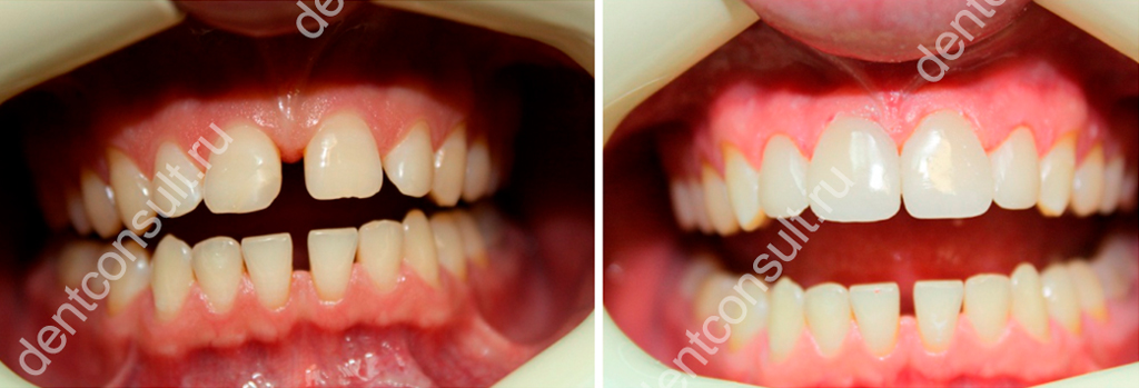 Установка виниров может помочь исправить проблему. Фото: dentconsult.ru