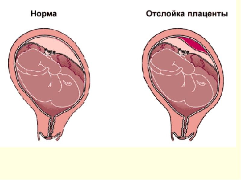 Презентация отслойка плаценты