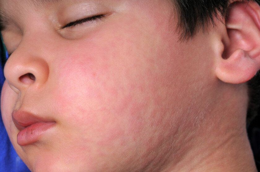 Аллергия у грудного ребёнка: кто виноват и что делать?