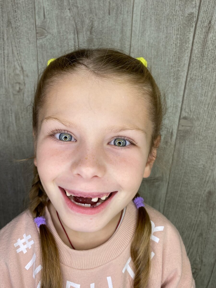 У Миланы происходит процесс смены молочных зубов на постоянные. Интересен тот факт, что молочные зубы начинают сформировываться на самых ранних сроках вынашивания плода. А вот прорезаются они, как правило, по достижении малышом полугодовалого возраста. Вопросом о том, сколько молочных зубов у детей должно быть, задаются многие мамы. Их комплект значительно отличается от постоянных. Например, если у взрослого человека должно быть 32 зуба, то молочных у маленьких детей – всего 20. Выпадение начинается уже после того, как сформируются постоянные. В основном данный процесс начинается с нижних резцов и занимает 6–8 лет.
#папа#отец#семья#дети#советы#факты