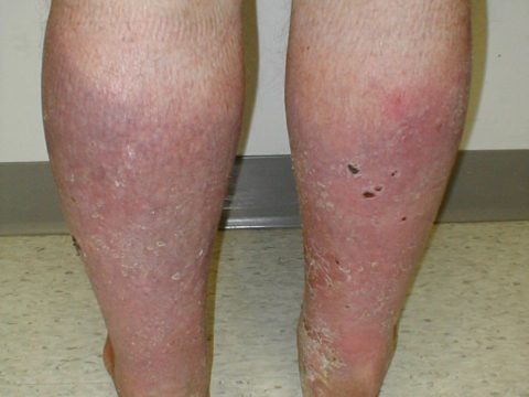  Фото: Сосудистые заболевания ног