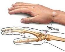 Шишка на запястье с внутренней стороны - гигрома: симптомы, причины, лечение