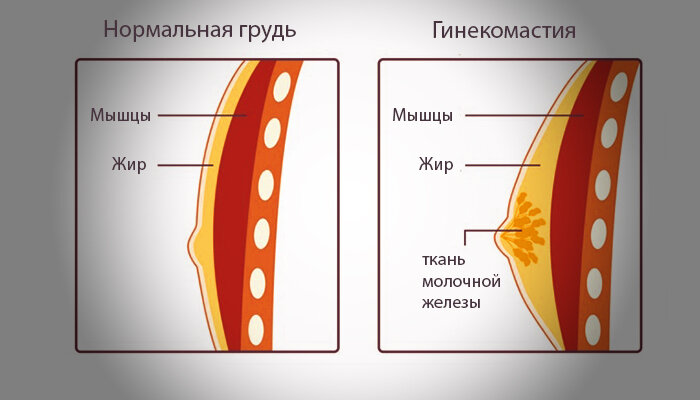 Нормальная грудь и грудь при гинекомастии.