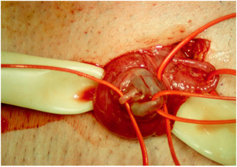 Микрохирургическая операция при варикоцеле