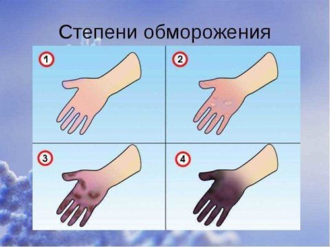  Любому человеку не помешает знать степени обморожения, а также присущие каждой симптомы и возможные последствия