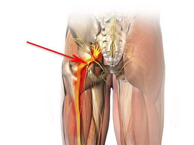 Болит наружная часть бедра сбоку