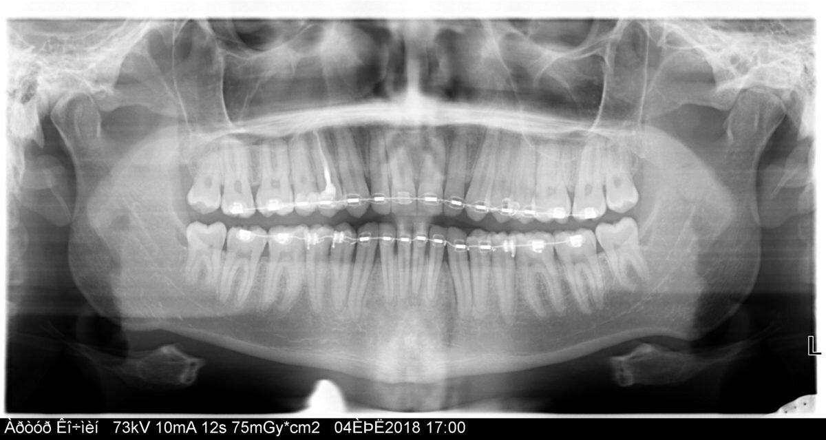 



b) Ортопантомограмма (ОПТГ) или иначе панорамный снимок
