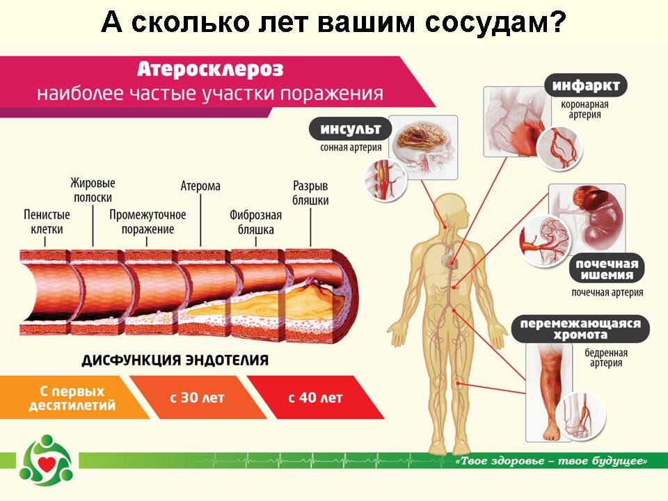 Лечение атеросклероза презентация