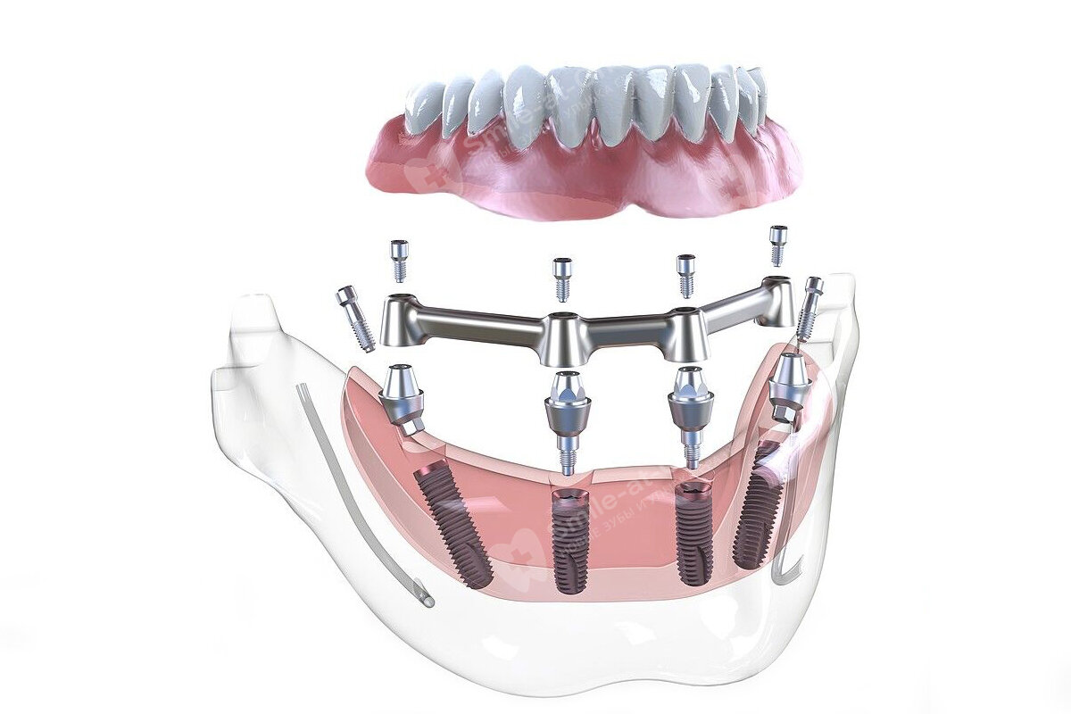 Несъемный зубной протез на 4 имплантах цена