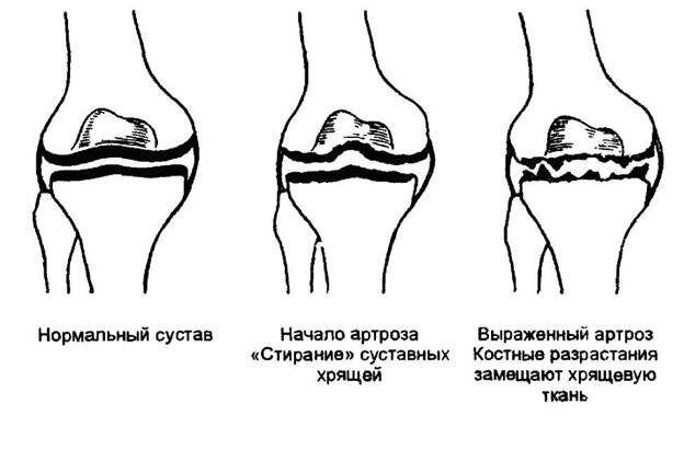 Лечение Деформирующий артроз коленного сустава (гонартроз) - Ортопедия Руслана Сергиенко