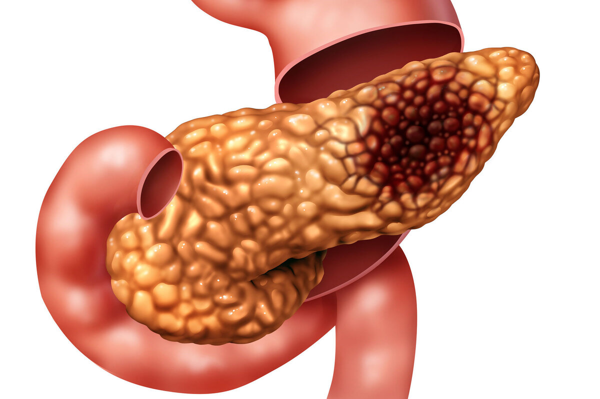 Что такое панкреатит - причины возникновения, симптомы и лечение | Миллион  вопросов о здоровье | Дзен