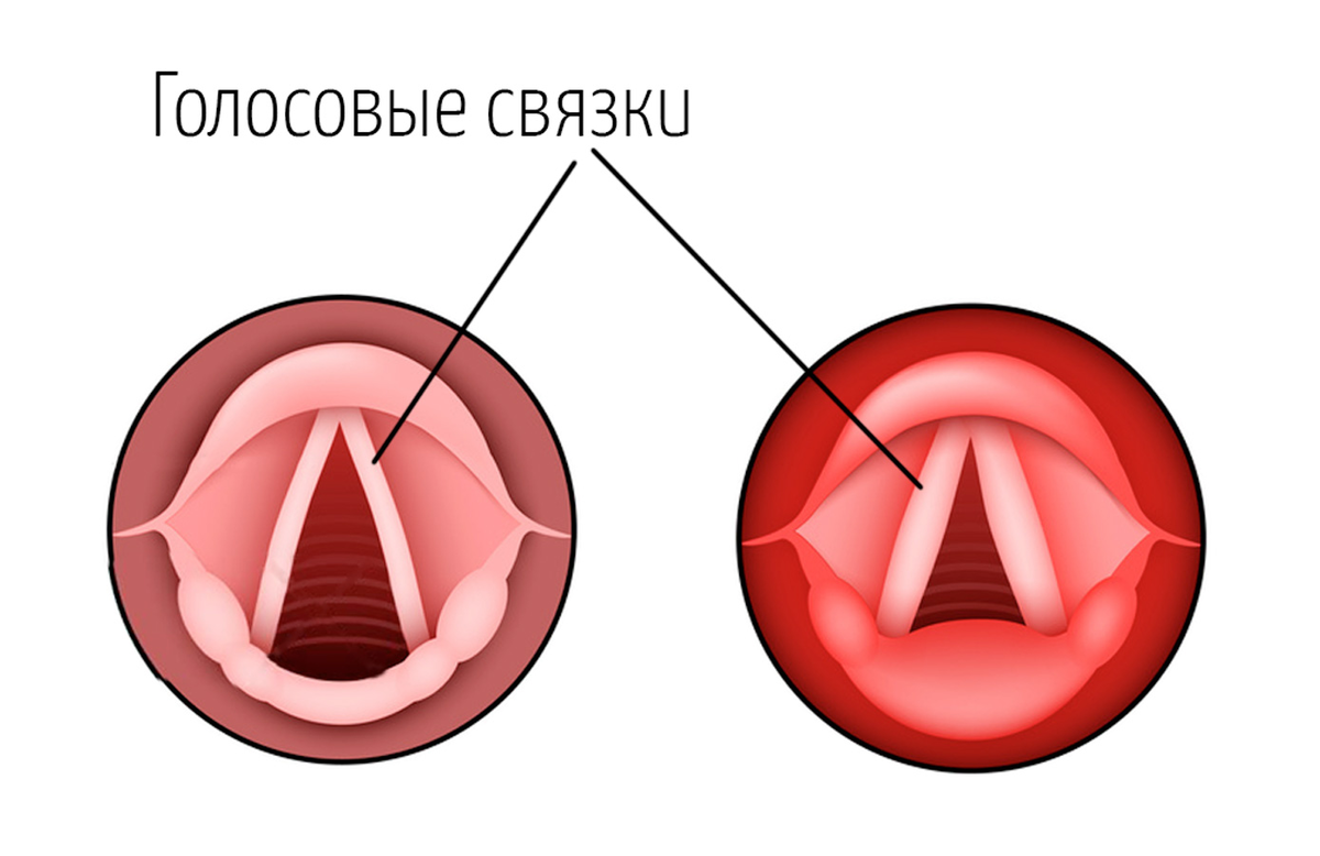 Ларингит и его последствия | Медицинский центр Е.В. Малышевой | Дзен