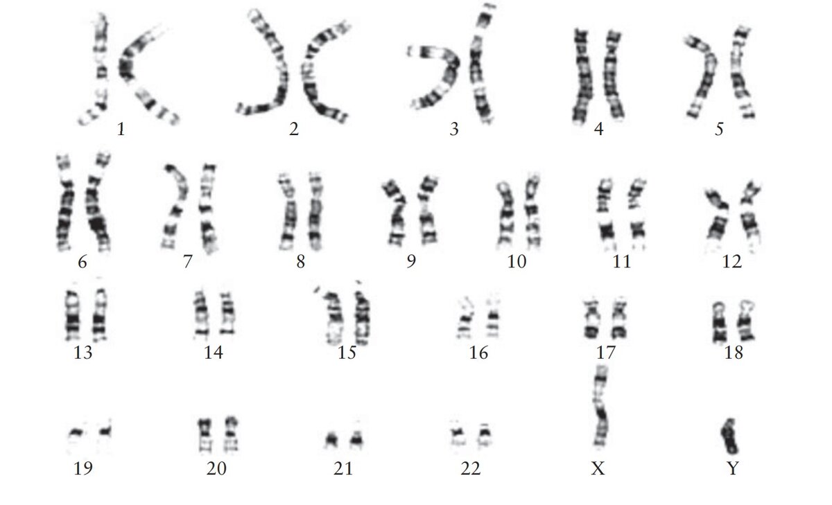 Y хромосома мужская. Кариограмма хромосом. Синдром Клайнфельтера кариограмма. Мужские хромосомы.