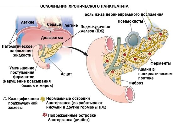 Панкреатит у ребенка