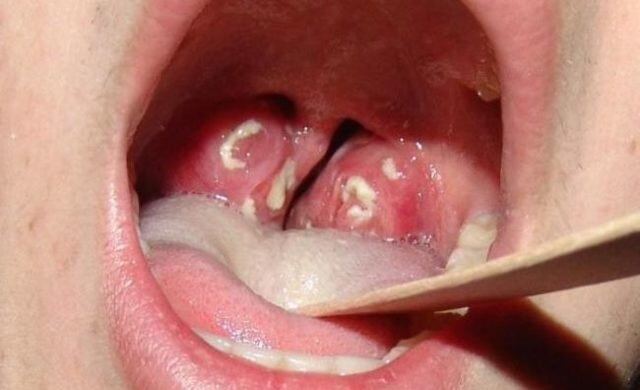 Гнойники в горле – это новообразования, которые заполнены гнойными массами. Они располагаются на слизистой оболочке и вследствие влияния некоторых факторов могут вскрываться.
 
 Гнойнички в горле – это большая проблема, так как они вызывают дискомфорт, болевые ощущения, свербят. При отсутствии элементарных правил профилактики белые гнойники вызывают осложнения.