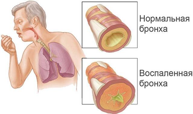 
Список проблем достаточно длинный. Лекарственное средство необходимо подбирать с учетом причинного фактора. Важно не только добиться откашливания, но и устранить патологию, течение которой сопровождается этим явлением.