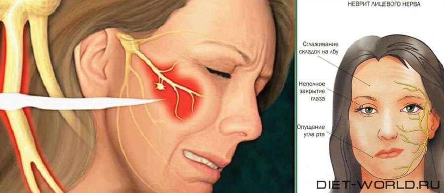 Лицевой нерв