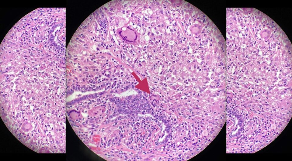   N + 1; Abdallah Mughrabi et al. / BMJ Case Reports, 2023