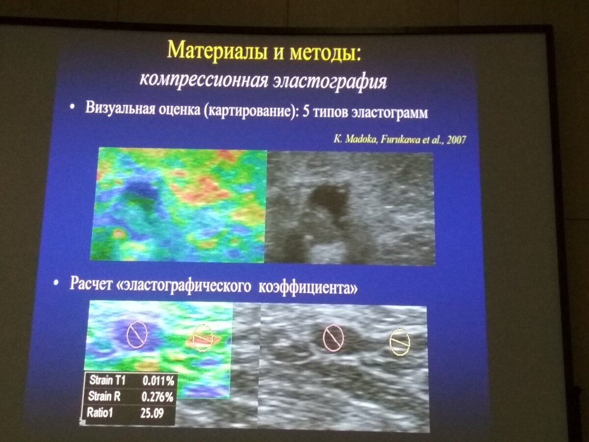 Лимфоузлы шеи при раке щитовидной железы - тема 3-го дня VIII Съезда врачей ультразвуковой диагностики