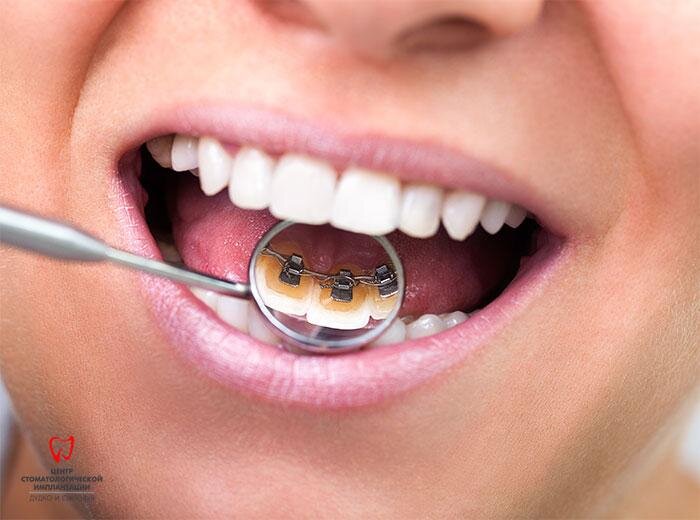 Лингвальная система брекетов