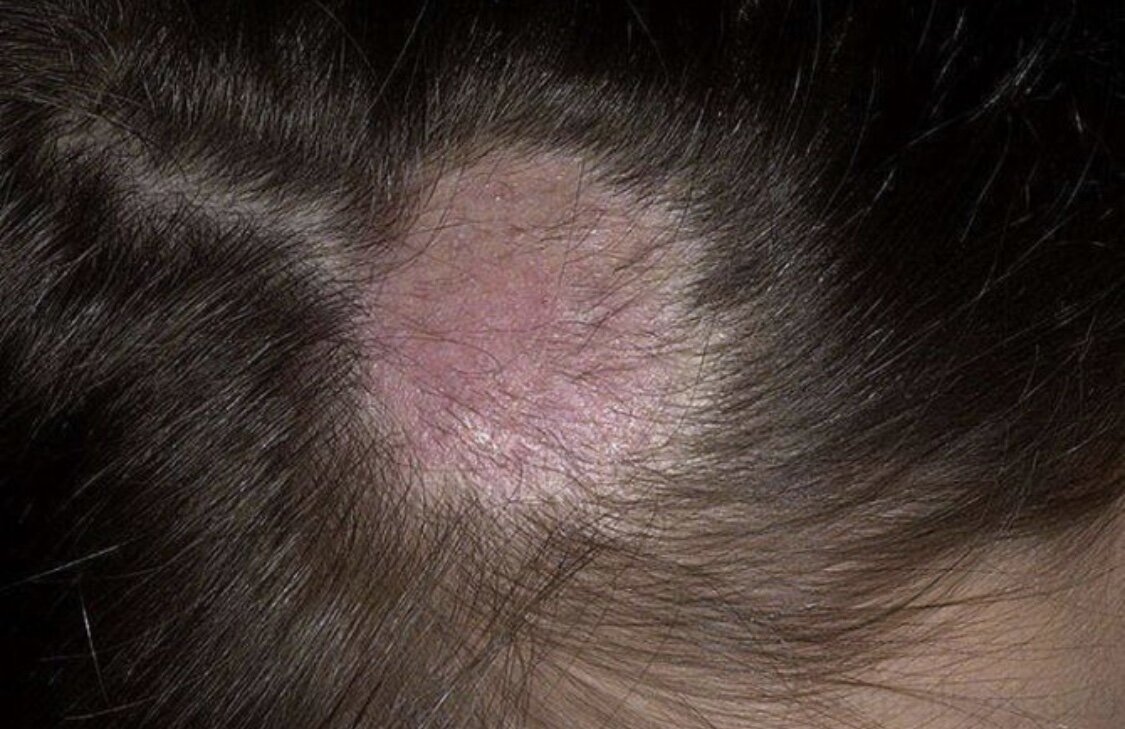 Вследствие данного заболевания образуются проплешины 