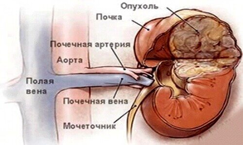 Ангиомиолипома почки - разновидность доброкачественной опухоли.