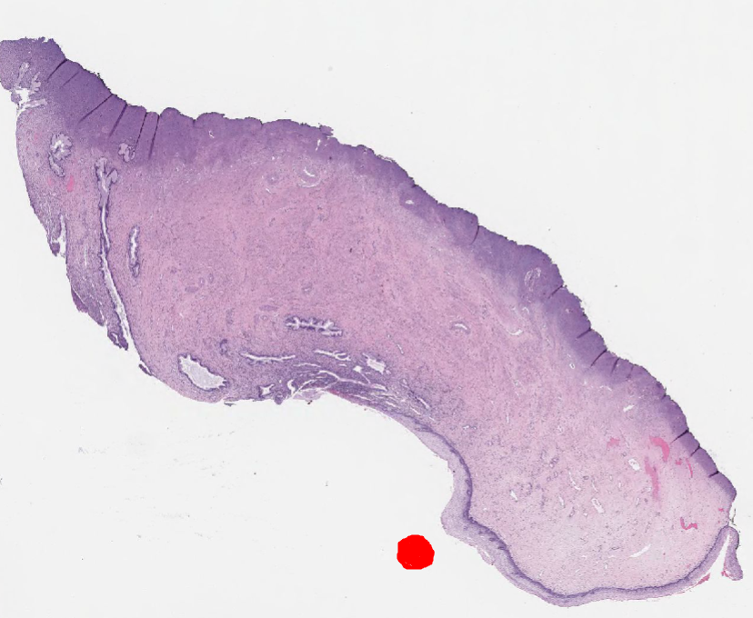 Матка микропрепарат гистология. Полип шейки матки гистология. Мезонефроидная карцинома гистология. Эндоцервикоз микропрепарат описание. Эритроплакия гистология.