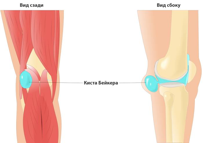 Киста Бейкера в коленном суставе