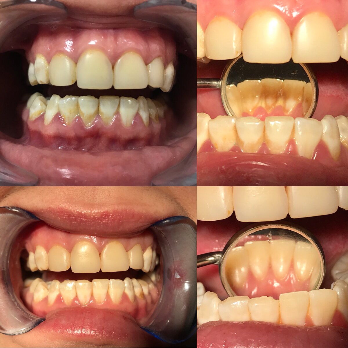 До и после снятия зубных отложений ( профессиональная гигиена полости рта)