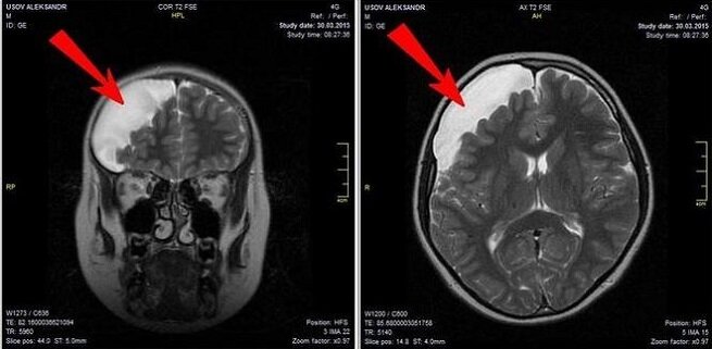 МРТ при кисте головного мозга
