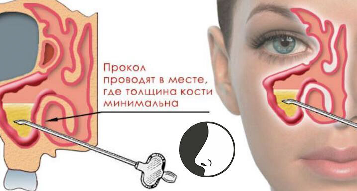 Синус катетер гайморит. Делать ли прокол при гайморите отзывы. Делать ли прокол при гайморите отзывы. Гайморит прокол гайморовой пазухи. Операция прокол гайморита.