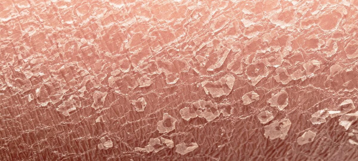 сухость крайней. мазь от покраснений на члене. сухость крайней. склероатрофический дерматоз. сухость крайней.