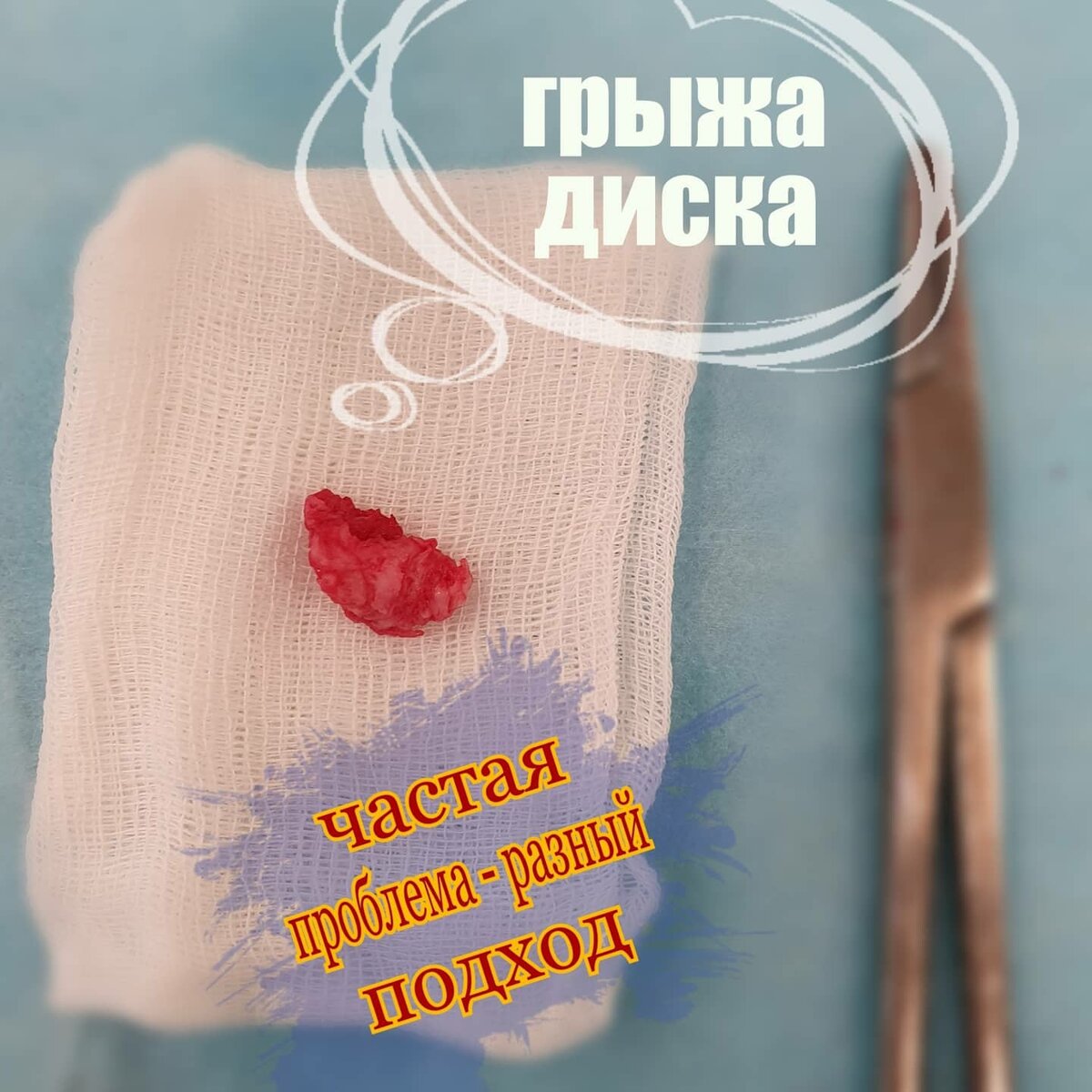 Грыжа диска.