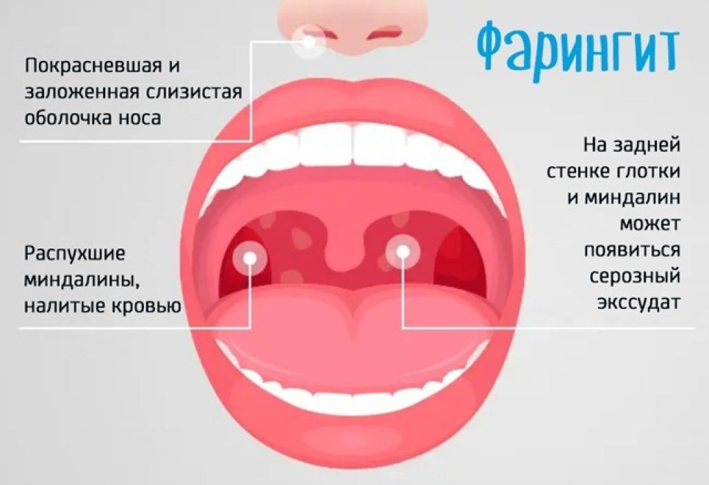 Чем лечат глотать. Хронический гранулезный фарингит. Гнойная ангина антибиотики вирусная. Вирусная герпесная ангина сыпь. Герпесвирусная ангина.