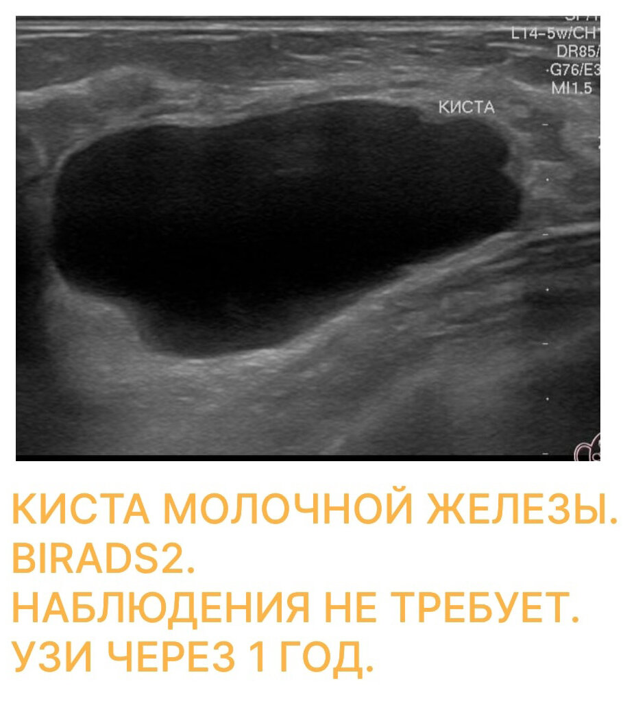 Фиброаденома молочной железы: диагностика, лечение и профилактика роста