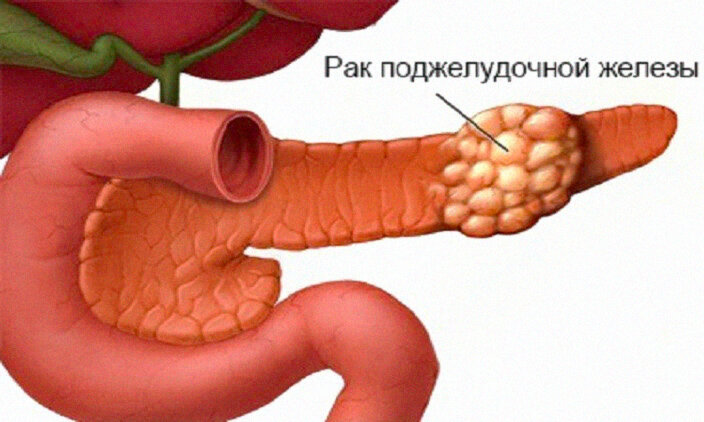 Когда пациенты обращаются к врачу, обычно уже слишком поздно для эффективного лечения.