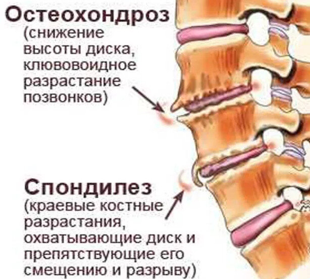 Виды спондилеза