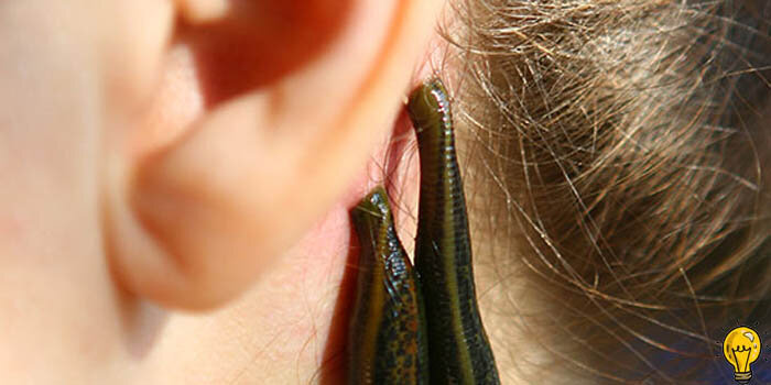 В древние времена люди клали кровососущих пиявок за уши. В отверстия, сделанные пиявками, было положено зерно опия, чтобы помочь больному спать.