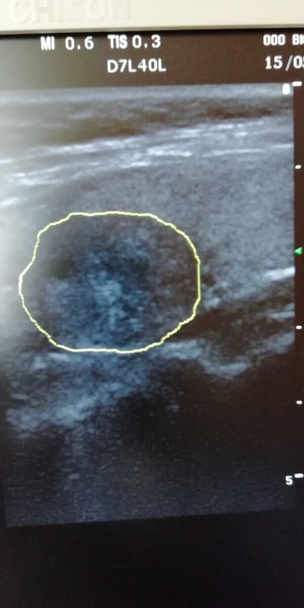 так выглядит крупный узел в правой доле щитовидной железы. фото автора.